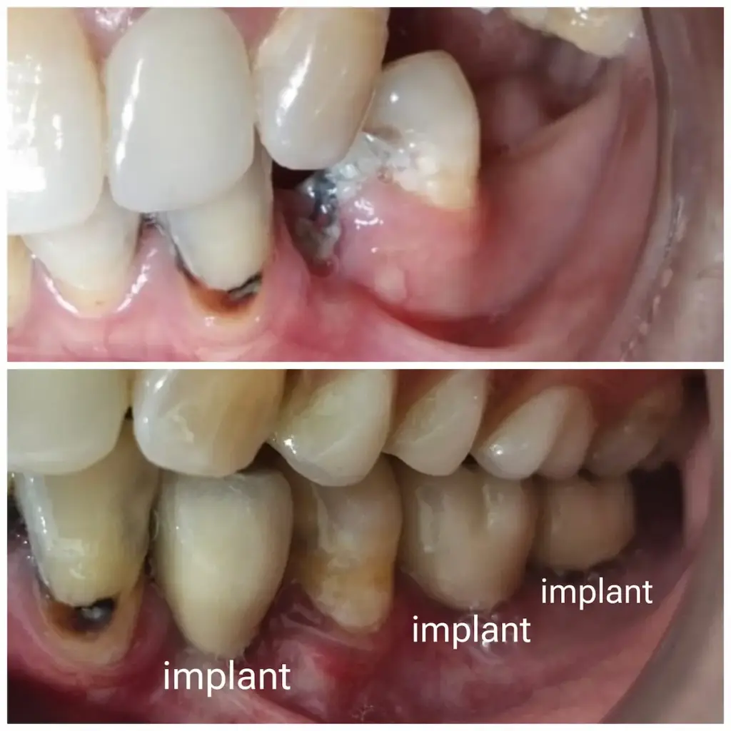 Implan Gigi Before After oleh New Smile Dental & Implant Center