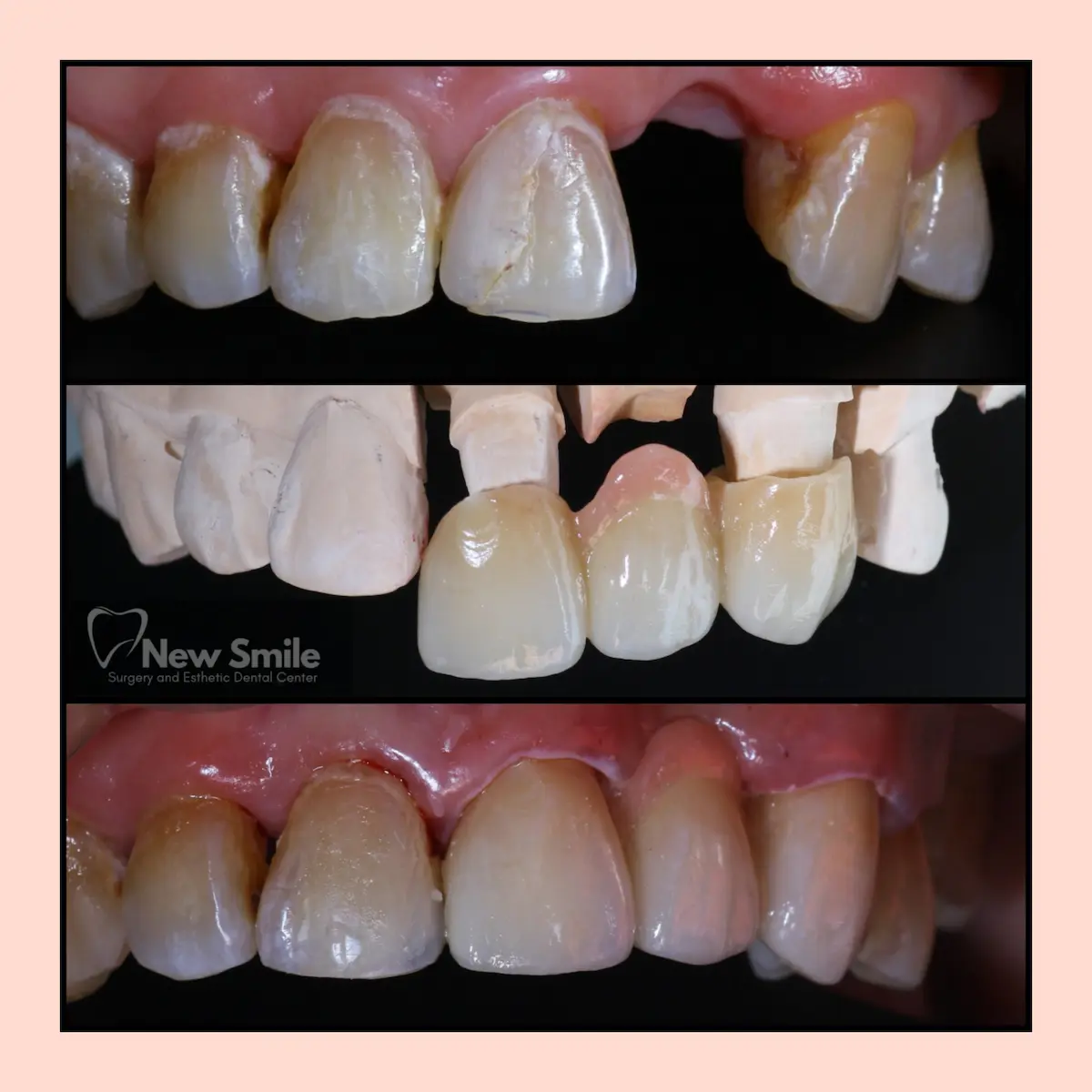Crown Bridge atau Gigi Palsu Permanen di Klinik Gigi Semarang - New Smile Dental & Implant Center