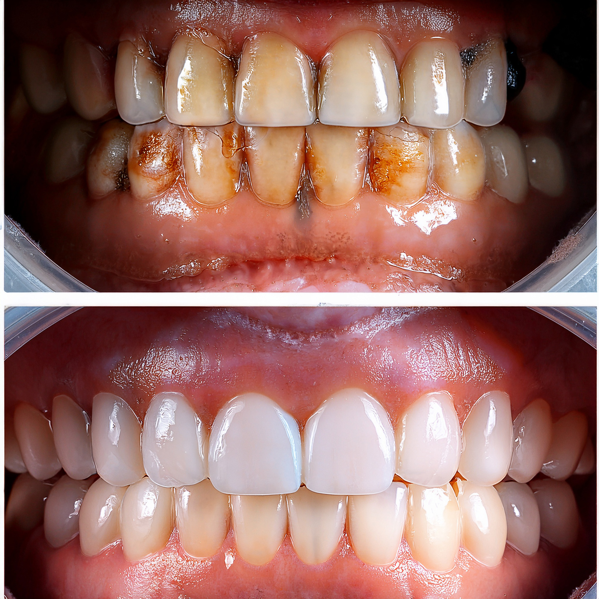 Full Mouth Rehabilitation di Klinik Gigi Semarang - New Smile Dental & Implant Center