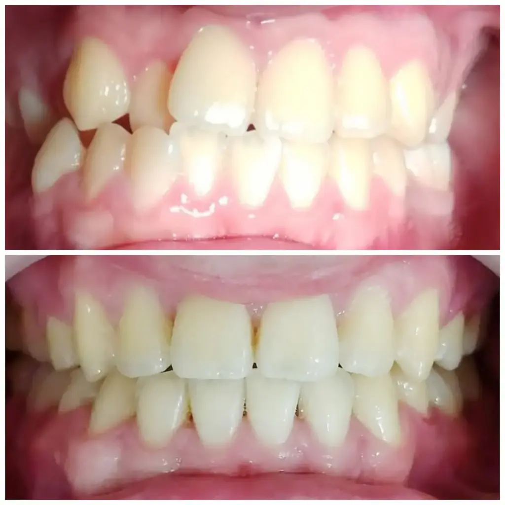 Before After Setelah Pemasangan Kawat Gigi / Behel di Klinik Gigi Semarang, New Smile Dental & Implant Center 01