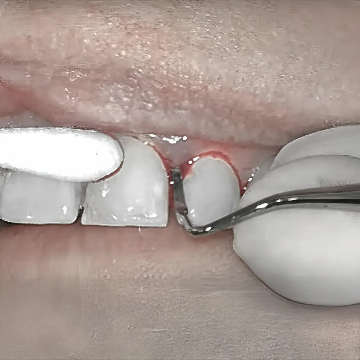 Kuretase di Klinik Gigi Semarang - New Smile Dental & Implant Center