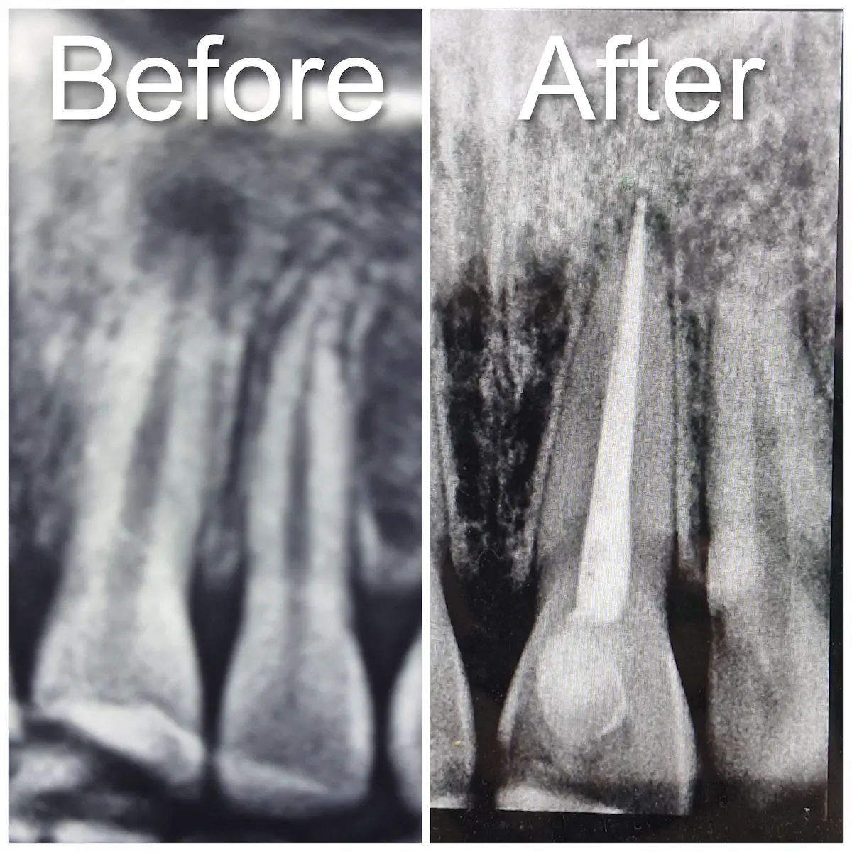 Perawatan Saraf oleh Klinik Gigi Semarang - New Smile Dental & Implant Center