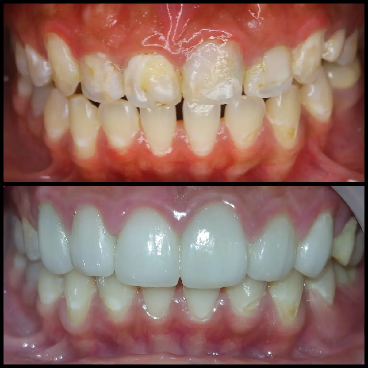 Veneers Porcelain di Klinik Gigi Semarang - New Smile Dental & Implant Center