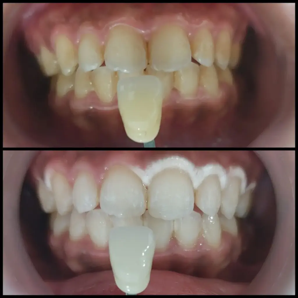 Bleaching Gigi Semarang - Before After