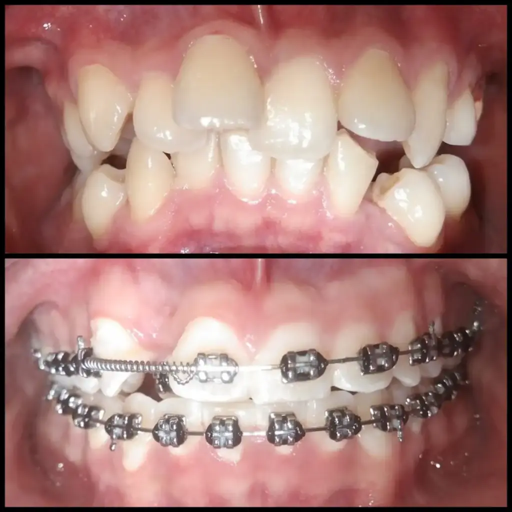Before After Layanan Behel Gigi Semarang di New Smile Dental and Implant Center