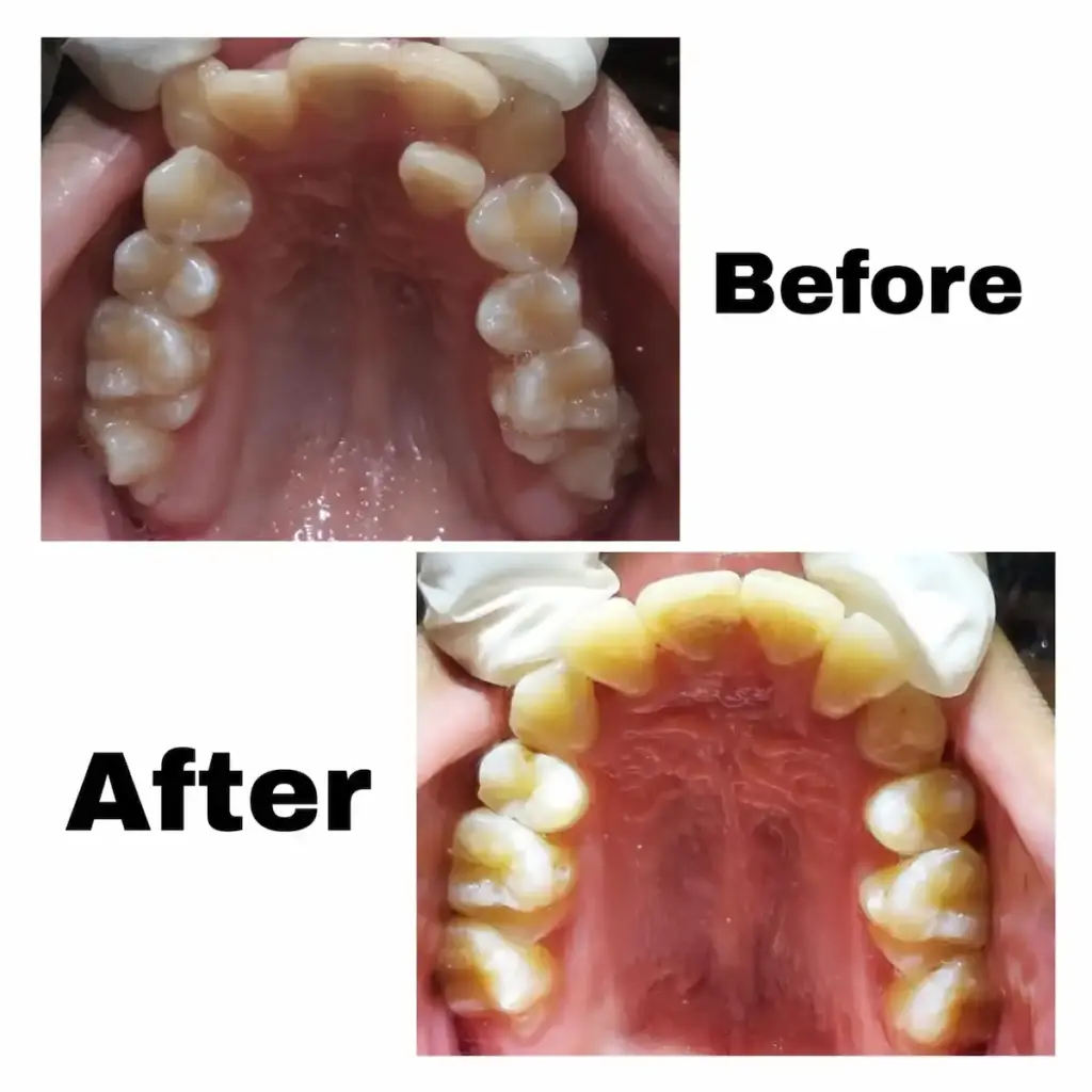 Before After Layanan Behel di Klinik Gigi Semarang - New Smile Dental & Implant Center
