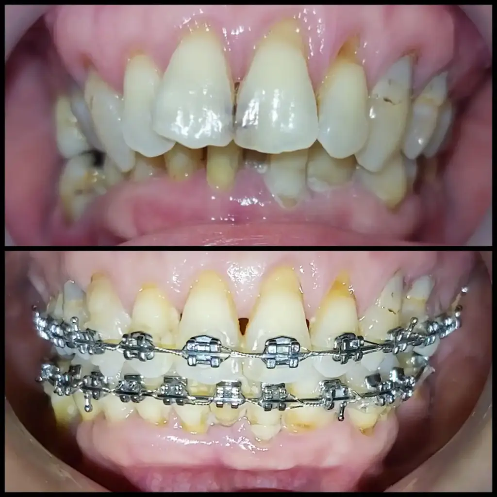 Before After Layanan Behel Semarang di New Smile Dental and Implant Center