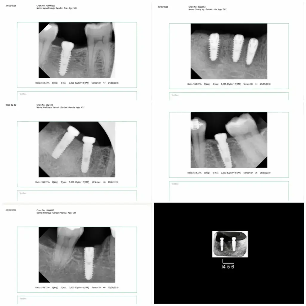 Dental Implant di Klinik Gigi Semarang - New Smile Dental and Implant Center