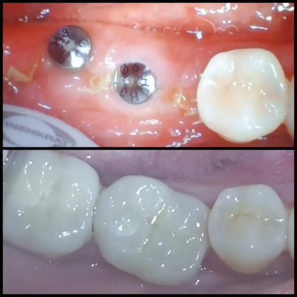 Implan Gigi di Klinik Gigi Semarang - New Smile Dental & Implant Center