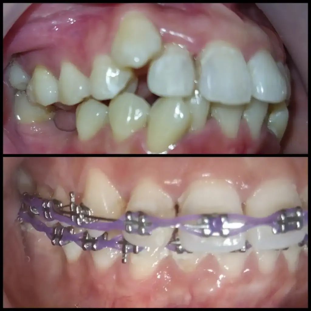 Before After Pasang Kawat Gigi di Klinik Gigi Semarang - New Smile Dental and
Implant Center