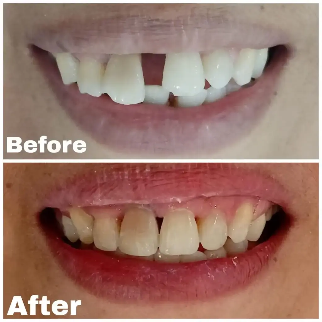 Before After Layanan Kawat Gigi di Klinik Gigi Semarang - New Smile Dental & Implant Center