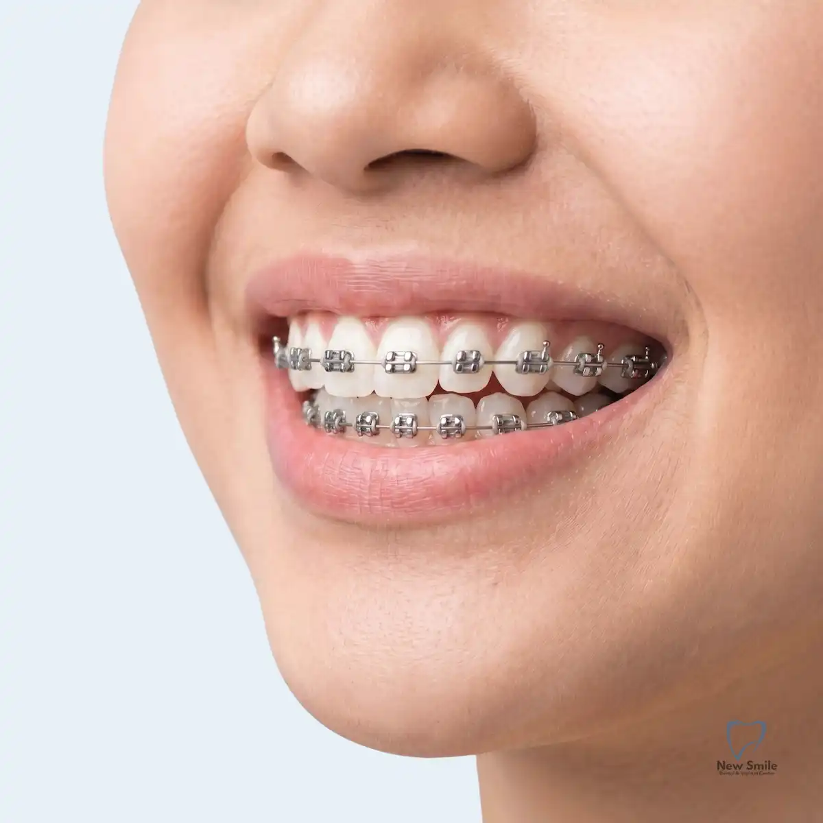 Pasang Behel Gigi - Kawat Gigi di New Smile Dental and Implant Center