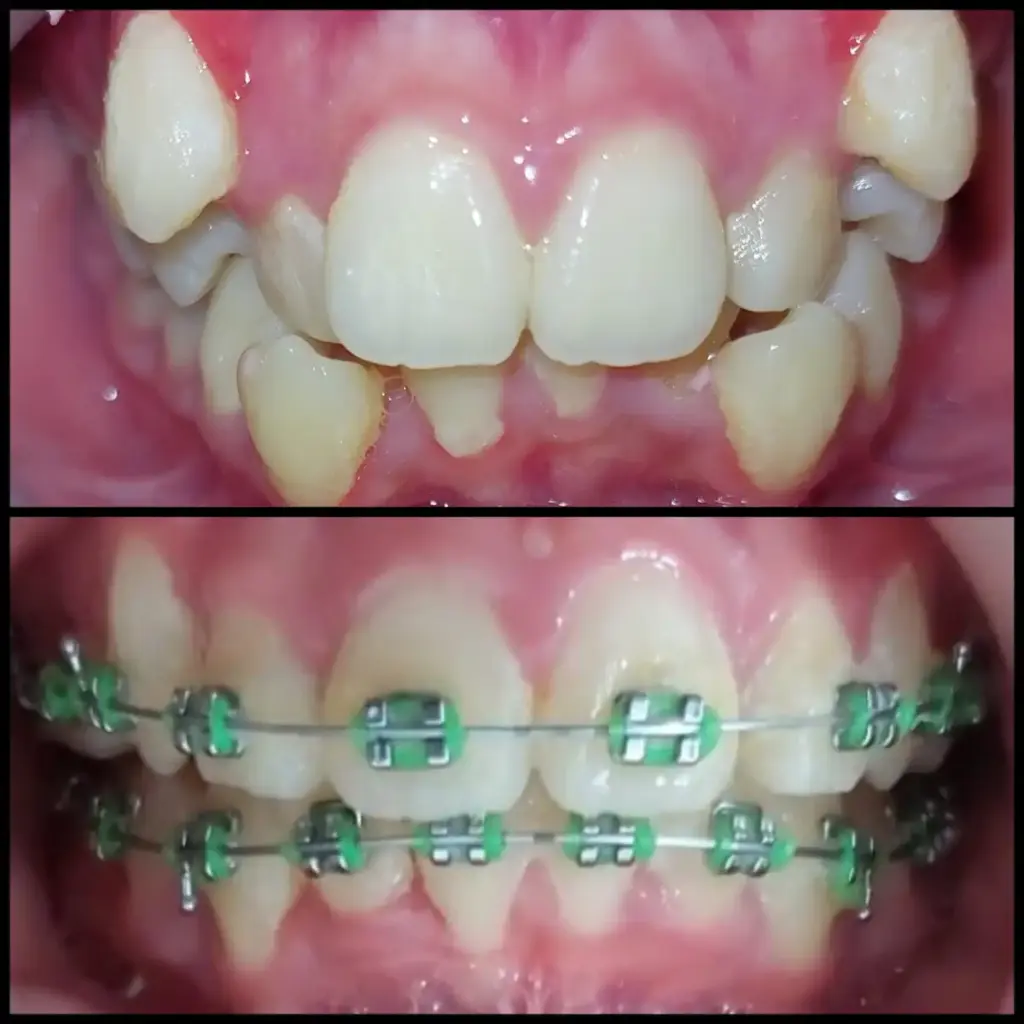 Before After Layanan Pasang Behel Gigi di Klinik Gigi Semarang - New Smile Dental and Implant Center