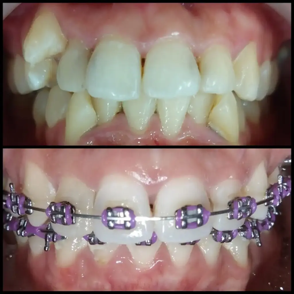 Before After Layanan Pasang Behel Gigi Semarang - New Smile Dental and Implant Center