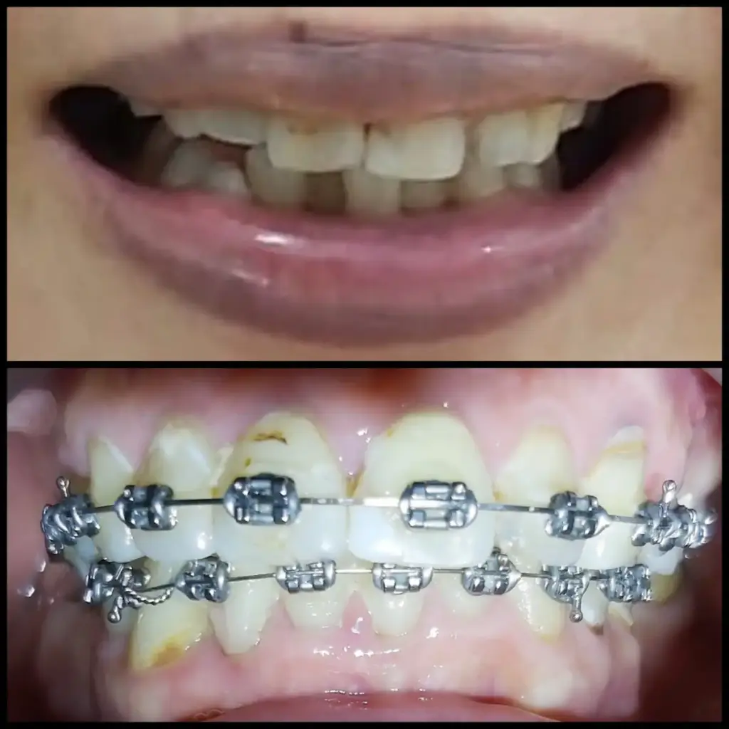 Before After Layanan Pasang Behel Gigi di Klinik Gigi Semarang - New Smile Dental and Implant Center