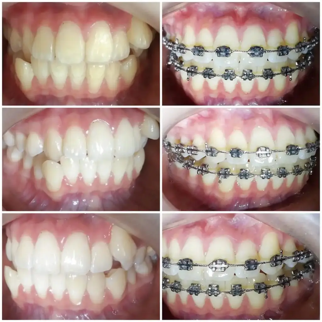 Before After Layanan Pasang Behel di Klinik Gigi Semarang - New Smile Dental and Implant Center