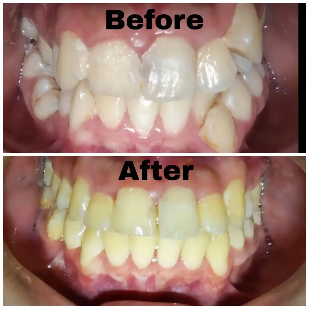 Before After Layanan Pasang Kawat Gigi di Klinik Gigi Semarang - New Smile Dental & Implant Center