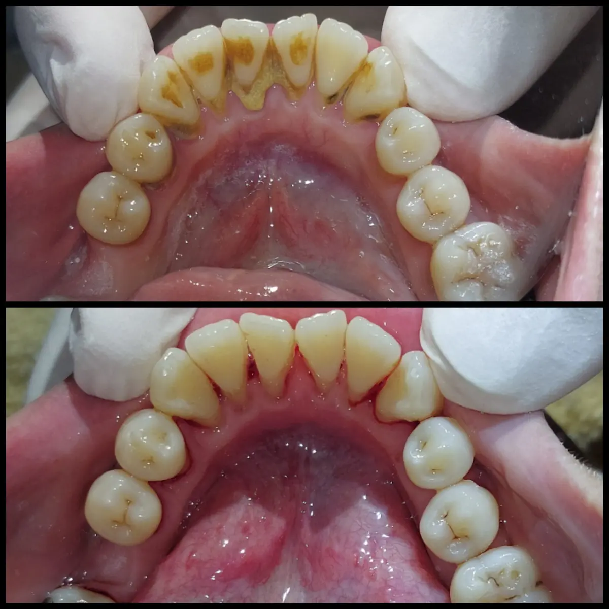 Scaling Gigi di Klinik Gigi Semarang - New Smile Dental & Implant Center