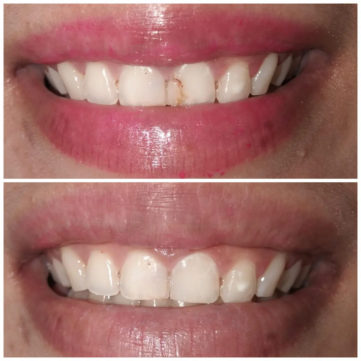 Tambal Gigi Before After di Klinik Gigi Semarang New Smile Dental & Implant Center