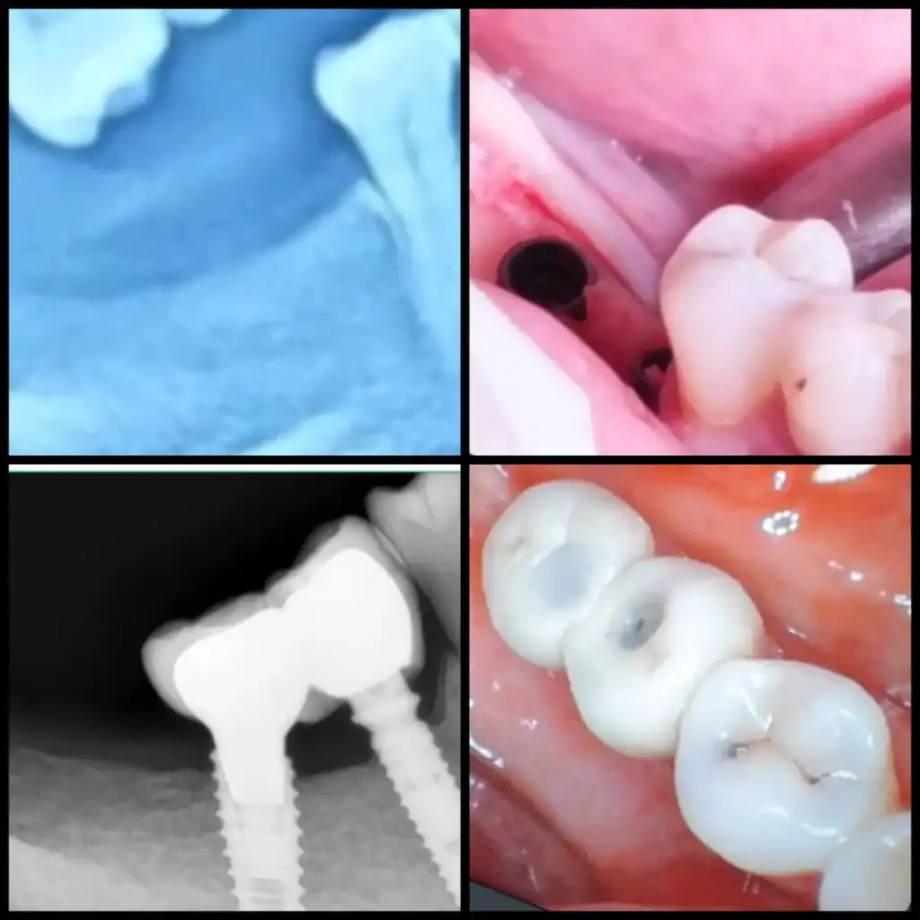Tanam Gigi di Klinik Gigi Semarang - New Smile Dental and Implant Center